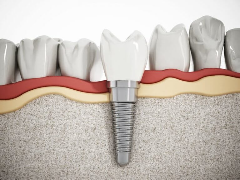 A. Scott Grivas III, DDS, INC. | How Much Do Dental Implants Cost Dental Implant Treatment Cost