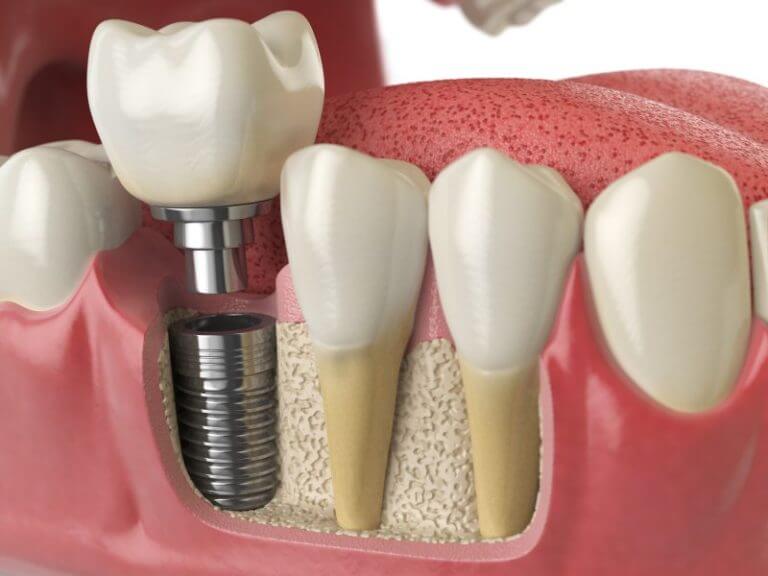 Dental Implants Service