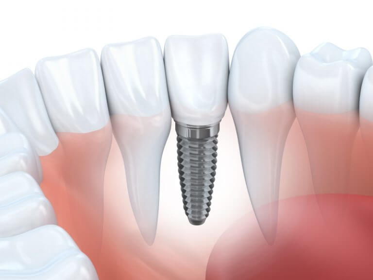 A. Scott Grivas III, DDS, INC. | How Much Do Dental Implants Cost Dental Implant Service Cost
