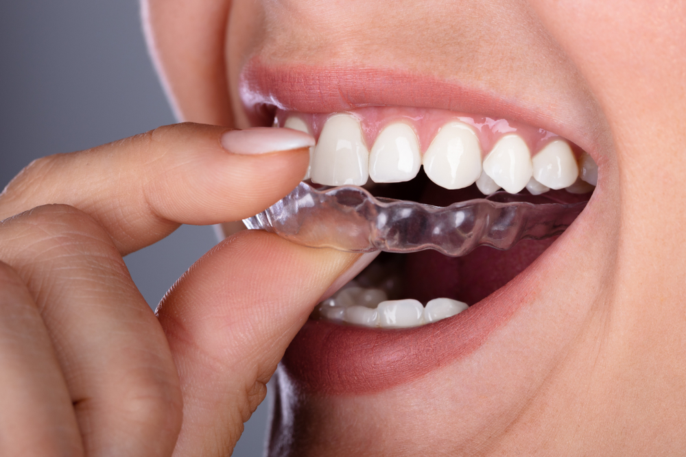 Invisalign Treatment