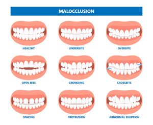 malocclusion chart