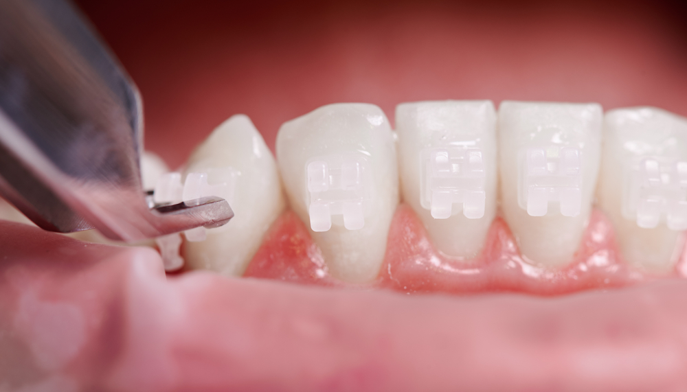 Cosmetic Invisalign Attachment