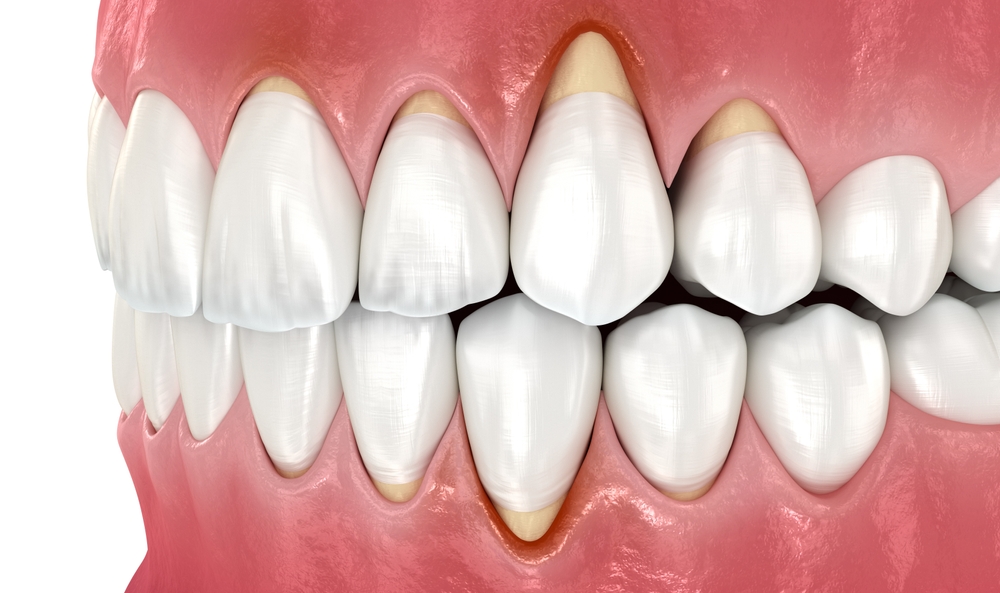 Gum Recession Treatment